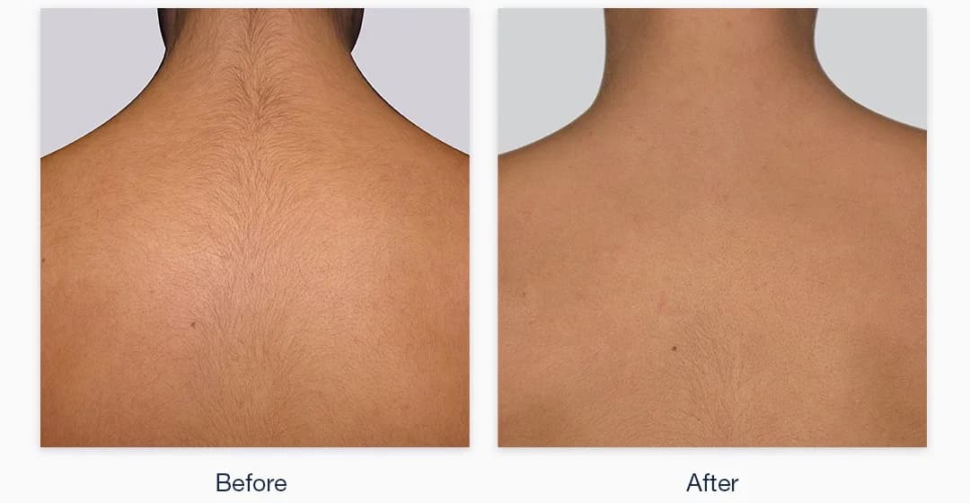 Laser Hair Removal Clinic in Langenhoven Park