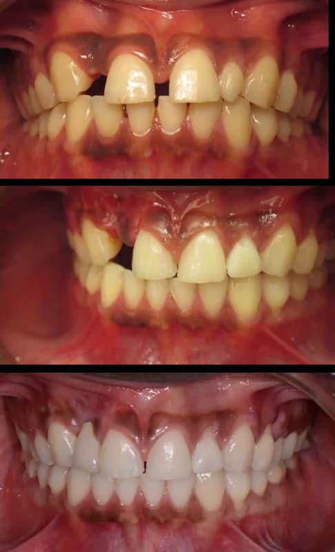 AlignIT Clear Aligners in Falomo