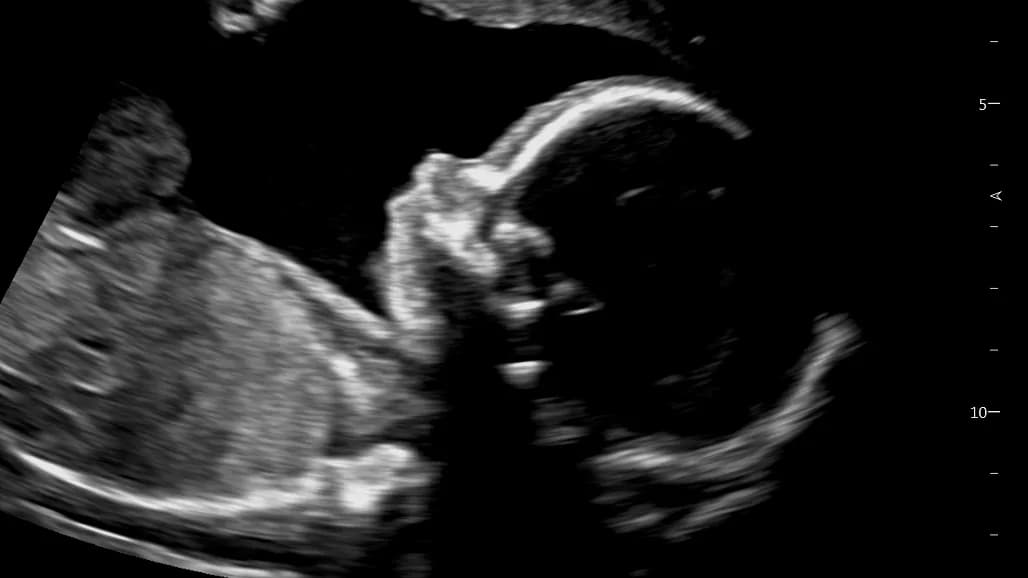 Fetal Sonography (Early health screening) in George South